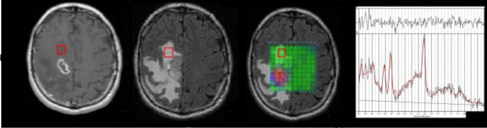 The left two images show a patient’s brain using different MR modalities, and the right image has our technique overlaid, as heatmaps indicating tissue grades.